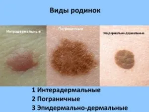 Як застосовувати чистотіл від родимок (родимок) Як застосовувати чистотіл від родимок