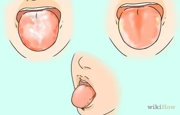 Як вирівняти зуби без брекетів, використовуючи invisalign (брекетів) Як вирівняти зуби без брекетів, використовуючи invisalign