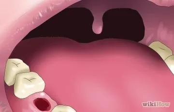 Як вирівняти зуби без брекетів, використовуючи invisalign (зуби) Як вирівняти зуби без брекетів, використовуючи invisalign