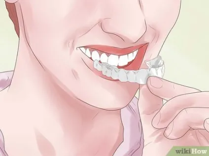 Як вирівняти зуби без брекетів, використовуючи invisalign (invisalign) Як вирівняти зуби без брекетів, використовуючи invisalign