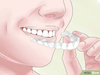 Як вирівняти зуби без брекетів, використовуючи invisalign (зуби) Як вирівняти зуби без брекетів, використовуючи invisalign