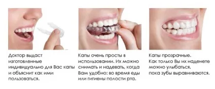 Капи для вирівнювання зубів і виправлення прикусу (зубів) Капи для вирівнювання зубів і виправлення прикусу