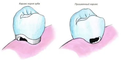 Карієс у дітей причини виникнення, методи лікування та профілактики