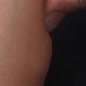 Жировики на тілі причини підшкірних жировик, чому і від чого з'являються, як позбутися від них, (жировики) Жировики на тілі причини підшкірних жировик, чому і від чого з'являються, як позбутися від них,
