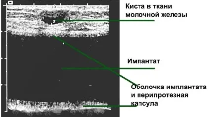 Жирова часточка в молочній залозі узі (часточка) Жирова часточка в молочній залозі узі