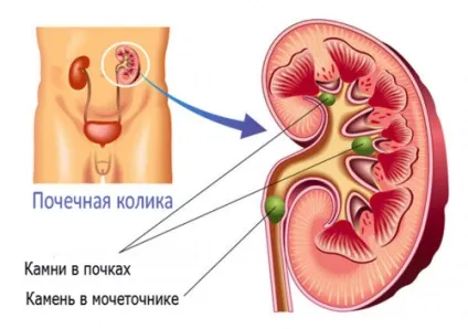 Журавлина для нирок користь і шкода при каменях (журавлина) Журавлина для нирок користь і шкода при каменях