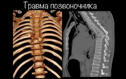 Комп'ютерна томографія хребта і наскільки важливі її переваги