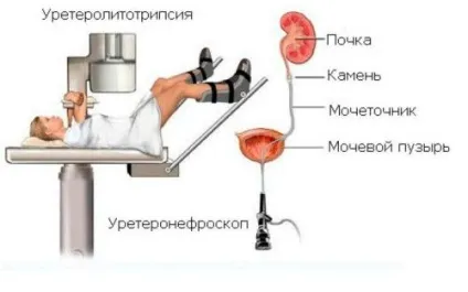 Контактна літотрипсія і безконтактна відгуки, показання до процедури (показання) Контактна літотрипсія і безконтактна відгуки, показання до процедури