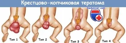 Крижово-куприкова тератома (крижово-куприкова тератома) Крижово-куприкова тератома
