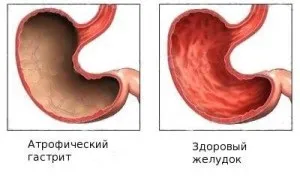 Лікування гастриту травами, фітотерапія при ерозивно і хронічному гастриті (фітотерапія) Лікування гастриту травами, фітотерапія при ерозивно і хронічному гастриті
