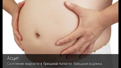Лікування асциту при цирозі печінки (асциту) Лікування асциту при цирозі печінки