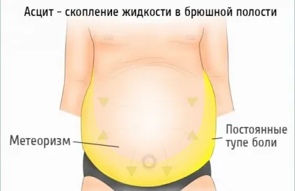 Лікування асциту при цирозі печінки (асциту) Лікування асциту при цирозі печінки
