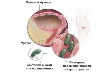 Лікування інфекції сечовивідних шляхів у дітей до року, симптоми у грудничка (інфекції) Лікування інфекції сечовивідних шляхів у дітей до року, симптоми у грудничка
