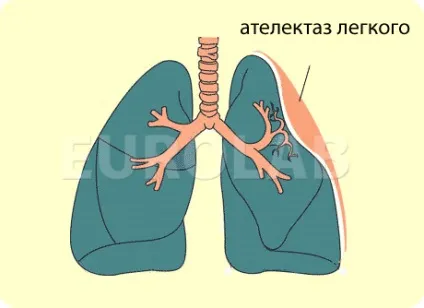 Лікування ателектазу легені - медичний портал eurolab (лікування) Лікування ателектазу легені - медичний портал eurolab