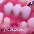 Лікування середнього карієсу (з подальшим відновленням) Лікування середнього карієсу