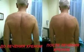 Листя хрону при остеохондрозі протипоказання, відео, відгуки