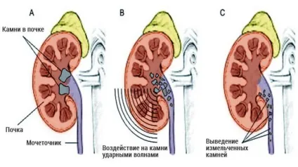 Літотрипсія каменів нирок дистанційна, лазерна, контактна, черезшкірна (каменів) Літотрипсія каменів нирок дистанційна, лазерна, контактна, черезшкірна
