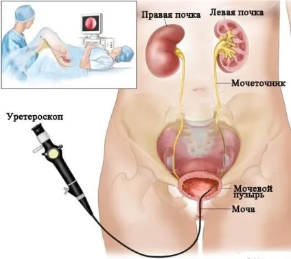 Літотрипсія каменів нирок дистанційна, лазерна, контактна, черезшкірна (дистанційна) Літотрипсія каменів нирок дистанційна, лазерна, контактна, черезшкірна