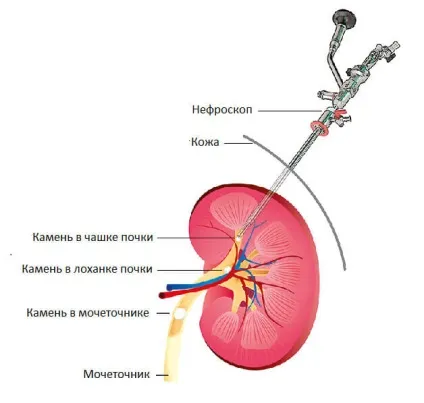 Літотрипсія каменів нирок дистанційна, лазерна, контактна, черезшкірна (літотрипсія) Літотрипсія каменів нирок дистанційна, лазерна, контактна, черезшкірна