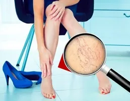 Кращі народні засоби для лікування і профілактики тромбофлебіту нижніх кінцівок (кошти) Кращі народні засоби для лікування і профілактики тромбофлебіту нижніх кінцівок
