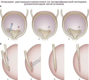 Мегауретер - фото, причини, симптоми, діагностика та лікування (мегауретер) Мегауретер - фото, причини, симптоми, діагностика та лікування