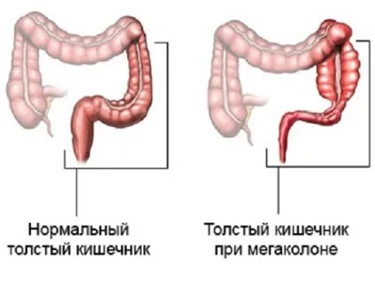 Мегаколон у дітей і дорослих причини виникнення, симптоми, діагностика та лікування (дорослих) Мегаколон у дітей і дорослих причини виникнення, симптоми, діагностика та лікування