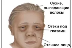 Мікседема причини, симптоми і лікування, профілактика хвороби (відео) (перший по гормонам) Мікседема причини, симптоми і лікування, профілактика хвороби (відео)