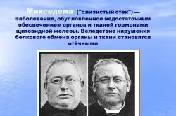 Мікседема причини, симптоми і лікування, профілактика хвороби (відео) (перший по гормонам) Мікседема причини, симптоми і лікування, профілактика хвороби (відео)