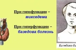 Мікседема причини, симптоми і лікування, профілактика хвороби (відео) (симптоми) Мікседема причини, симптоми і лікування, профілактика хвороби (відео)