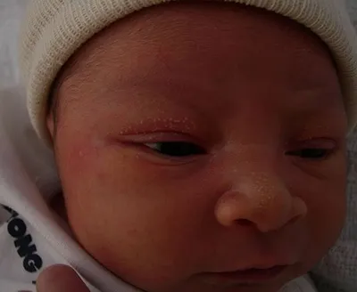 Міліуми на обличчі як позбутися від просянок на столітті під очима в домашніх умовах (очима) Міліуми на обличчі як позбутися від просянок на столітті під очима в домашніх умовах