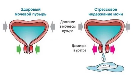 Сеча не тримається і що робити стресовий і ургентне нетримання (стресовий) Сеча не тримається і що робити стресовий і ургентне нетримання