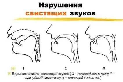 Міжзубний сигматизм види сигматизм і корекція (корекція) Міжзубний сигматизм види сигматизм і корекція
