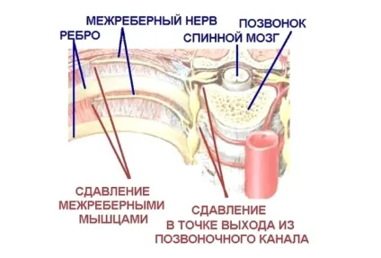 Міжреберна невралгія симптоми та лікування (лікування) Міжреберна невралгія симптоми та лікування