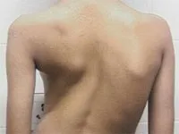 Чи можна потрапити в армію зі сколіозом 2 ступеня (ступеня) Чи можна потрапити в армію зі сколіозом 2 ступеня