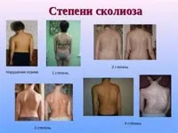Чи можна потрапити в армію зі сколіозом 2 ступеня (можна) Чи можна потрапити в армію зі сколіозом 2 ступеня