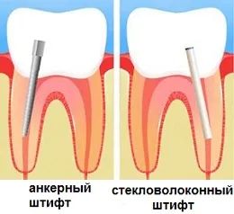Чи можна відновити сильно зруйновані зуби (зруйновані) Чи можна відновити сильно зруйновані зуби