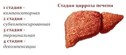 Чи можна вилікувати цироз печінки скільки живуть і як умирають (можна) Чи можна вилікувати цироз печінки скільки живуть і як умирають