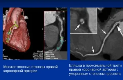 МСКТ серця (коронарографія) з контрастуванням (контрастуванням) МСКТ серця (коронарографія) з контрастуванням
