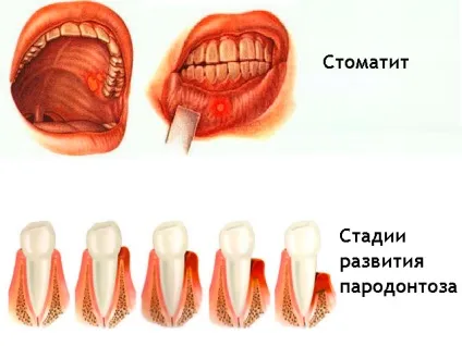 Чи можна мед при стоматиті (Хвороби лікування Шершень Джміль) Чи можна мед при стоматиті