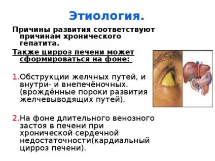 Чи можна вилікувати цироз печінки скільки живуть і як умирають (вилікувати) Чи можна вилікувати цироз печінки скільки живуть і як умирають