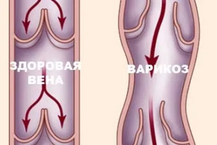 Початкова стадія варикозу фото, симптоми і лікування (початкова стадія варикоз фото симптоми лікування) Початкова стадія варикозу фото, симптоми і лікування