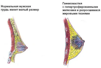 Чоловічі проблеми з грудьми що робити з гинекомастией (операції пластичної хірургії) Чоловічі проблеми з грудьми що робити з гинекомастией