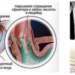 Недостатність кардіального жому симптоми, лікування, стравохід wiki (недостатність) Недостатність кардіального жому симптоми, лікування, стравохід wiki