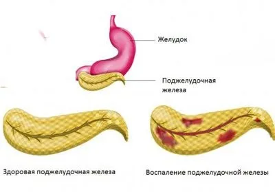Настоянка часнику на спирту для чищення судин схема застосування, рецепт (чистки) Настоянка часнику на спирту для чищення судин схема застосування, рецепт