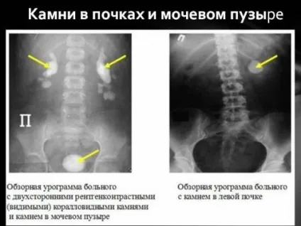 Оглядова урографія нирок підготовка до процедури і як вона проводиться