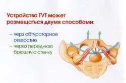 Операція при нетриманні сечі (tvt-o) (нетриманні) Операція при нетриманні сечі (tvt-o)