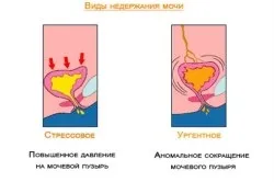 Операція при нетриманні сечі (tvt-o) (варто звернутися лікаря) Операція при нетриманні сечі (tvt-o)