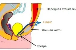 Операція при нетриманні сечі (tvt-o) (нетриманні) Операція при нетриманні сечі (tvt-o)