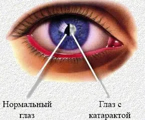 Операція з видалення катаракти