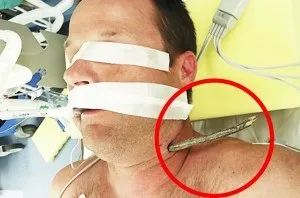 Надання першої допомоги при пораненні шиї особливості та рекомендації (першої) Надання першої допомоги при пораненні шиї особливості та рекомендації